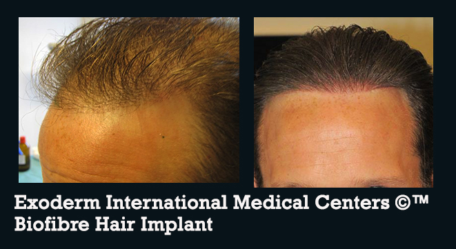 Biofibre-hair-implant-Exoderm